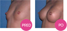zvětšení prsou bez operace