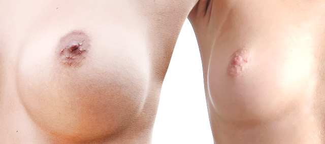 breast enlargement without surgery