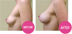 natural breast augmentation