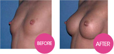 breast enlargement without surgery