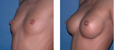 natural breast enhancement