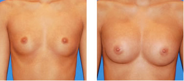 natural breast enlargement